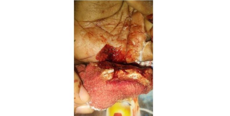 6-Y-O Mon Repos student attacked with broken lemonade bottle at school