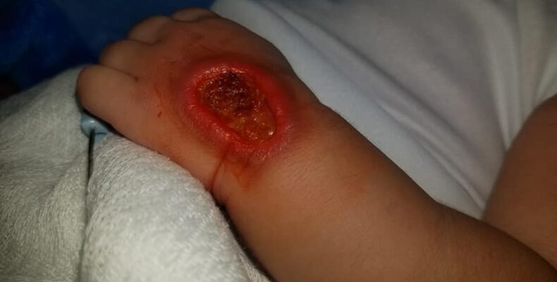 Newborn left with gaping hole on hand from burn at New Amsterdam Hospital