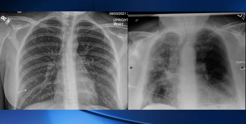 Some COVID patients showing signs of other health complications after recovering -Health Minister