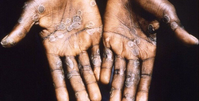 WHO: World faces big challenges over COVID, monkeypox and wars