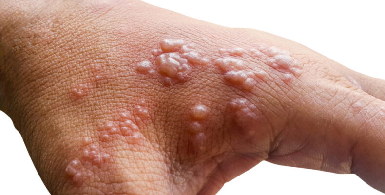 UPDATE: 57-Y-O man is Guyana’s first monkeypox case; Health Minister says ‘don’t panic’
