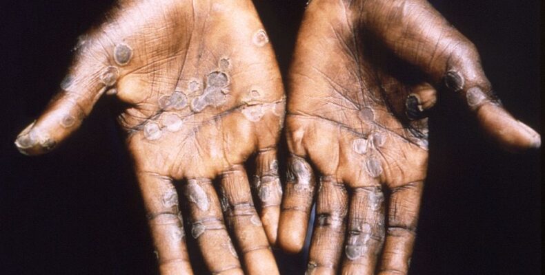 BREAKING: First monkeypox case confirmed in Guyana