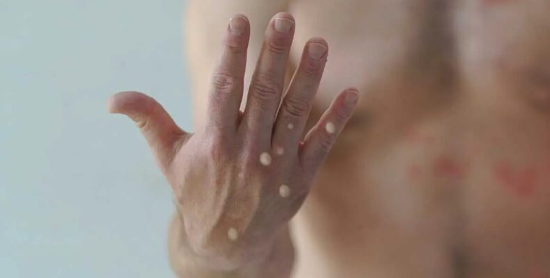 Monkeypox could spread more if treated as ‘gay plague’ – SASOD warns